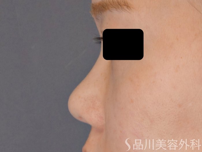 症例NO.72184のBEFORE写真