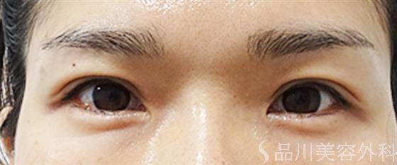 症例NO.53744のAFTER写真