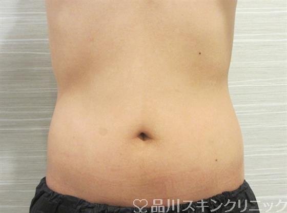 症例NO.33132のAFTER写真