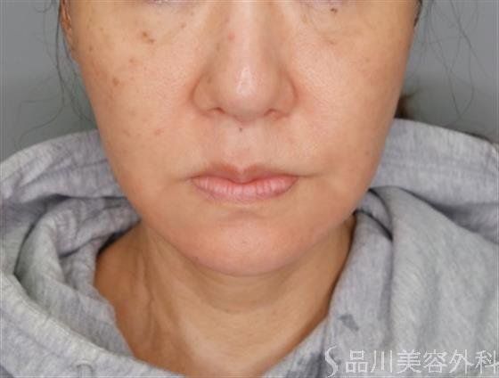 症例NO.55033のBEFORE写真