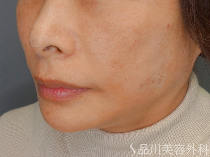 症例NO.73431のAFTER写真