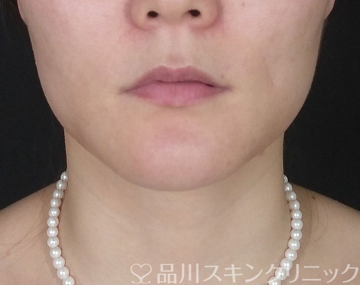 症例NO.66665のBEFORE写真