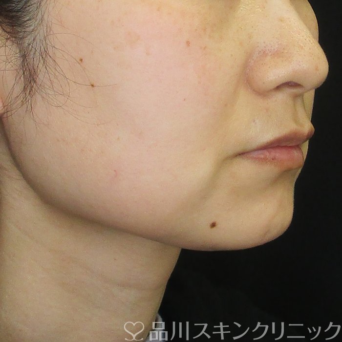 症例NO.74162のBEFORE写真
