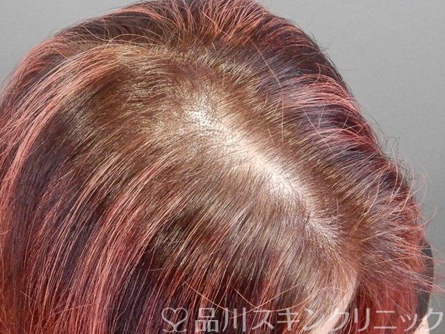 症例NO.69020のBEFORE写真