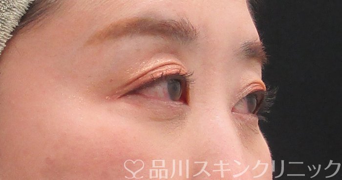 症例NO.75301のBEFORE写真