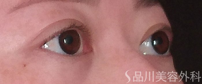 症例NO.69916のBEFORE写真
