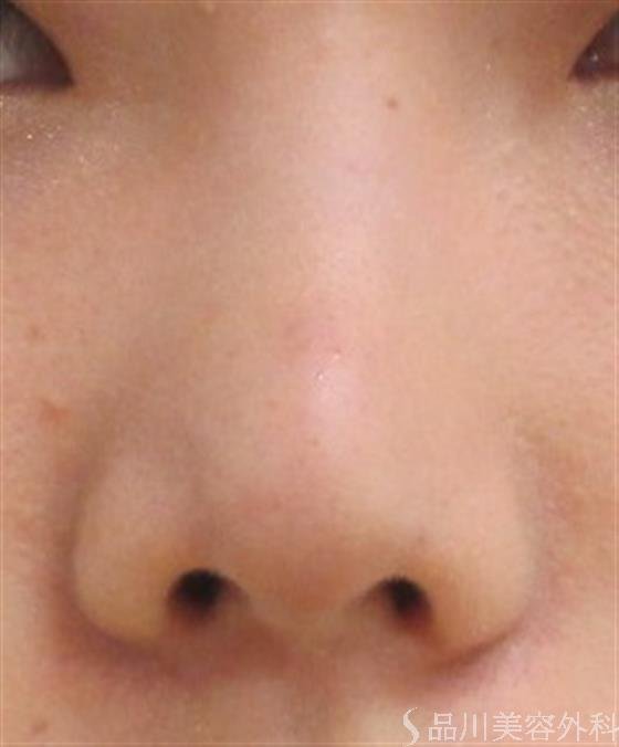 症例NO.22125のAFTER写真