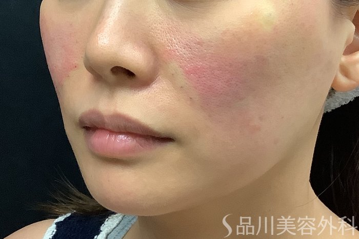 症例NO.71581のAFTER写真