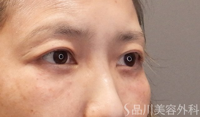 症例NO.75041のAFTER写真