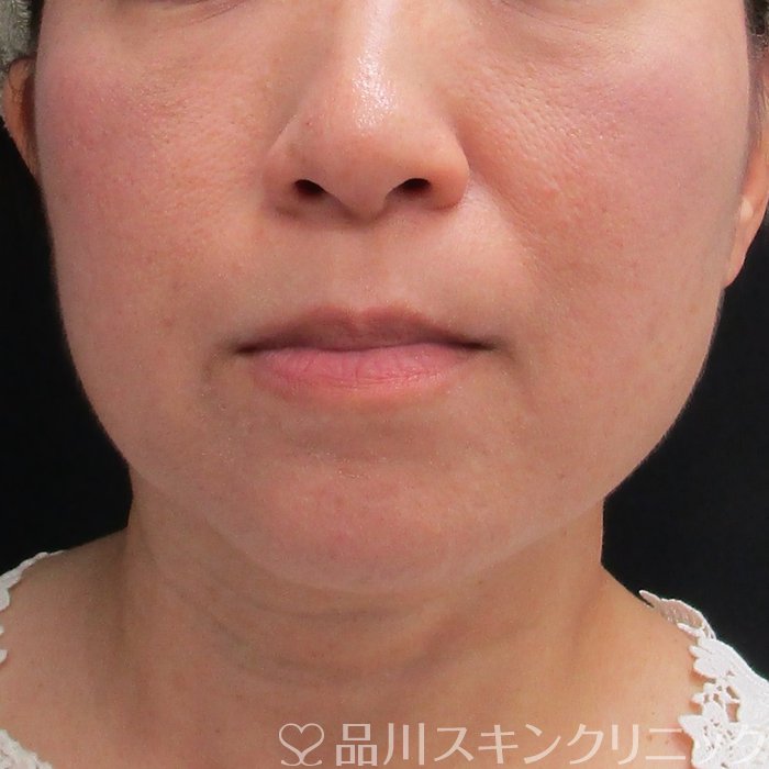 症例NO.74474のBEFORE写真