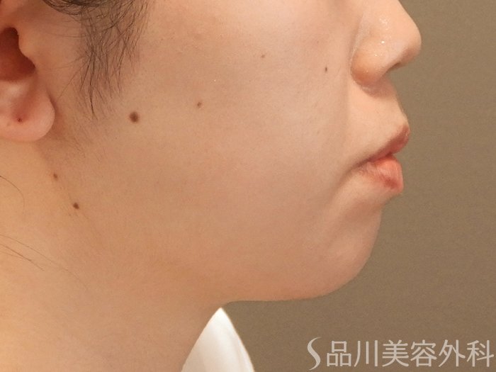 症例NO.70972のBEFORE写真