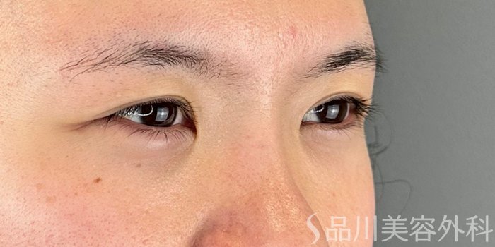 症例NO.70305のBEFORE写真