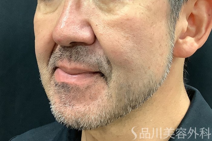 症例NO.71246のBEFORE写真