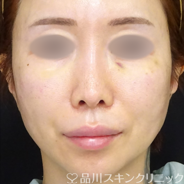 症例NO.69391のAFTER写真