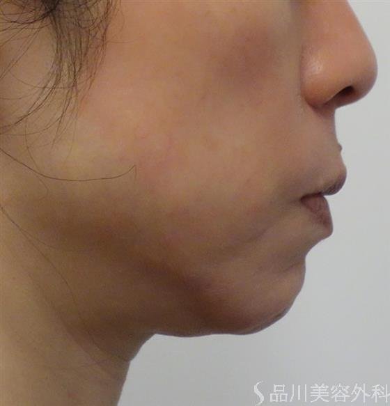 症例NO.50046のBEFORE写真