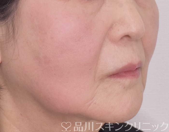症例NO.69886のBEFORE写真