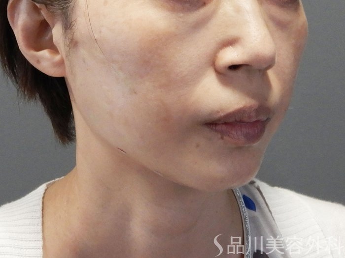 症例NO.72043のAFTER写真