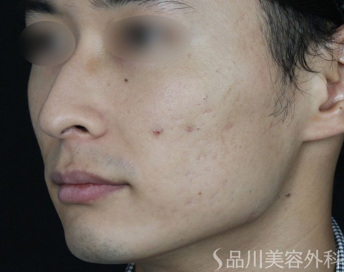 症例NO.67499のBEFORE写真