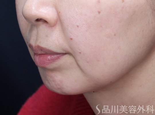 症例NO.73442のBEFORE写真