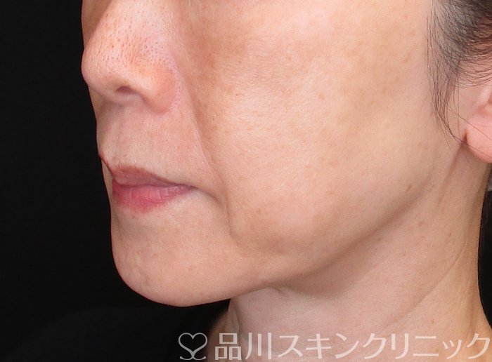 症例NO.75135のBEFORE写真