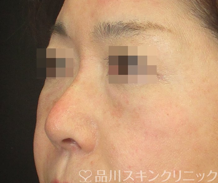 症例NO.73735のAFTER写真