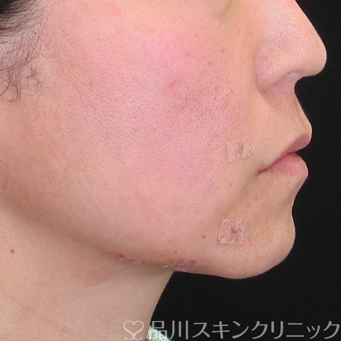 症例NO.75073のAFTER写真
