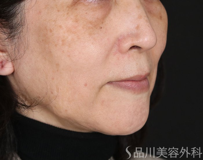 症例NO.72658のBEFORE写真