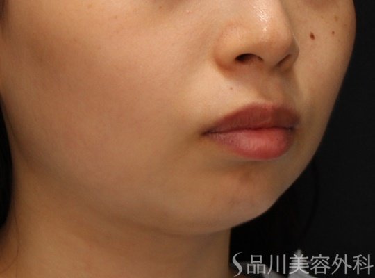 症例NO.69457のBEFORE写真