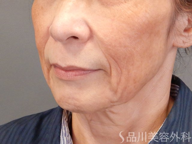 症例NO.75106のBEFORE写真