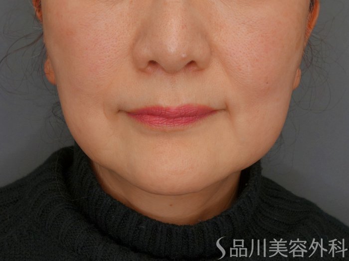 症例NO.63307のBEFORE写真