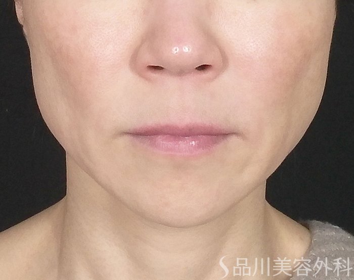 症例NO.63914のBEFORE写真