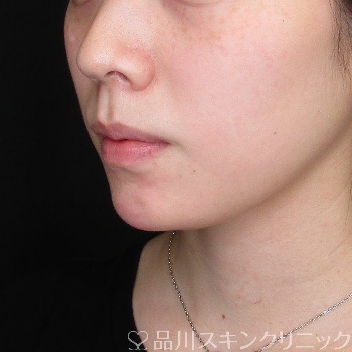 症例NO.74438のAFTER写真
