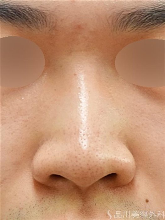 症例NO.34451のBEFORE写真