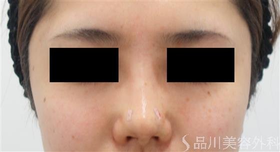 症例NO.40453のAFTER写真