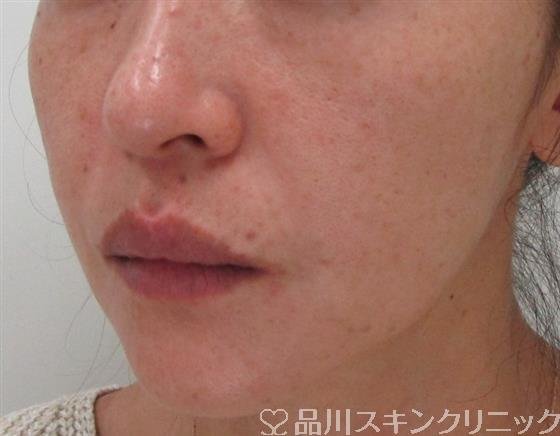 症例NO.32327のAFTER写真