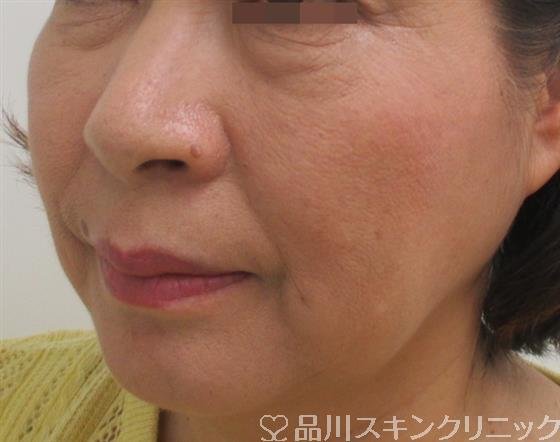 症例NO.26429のBEFORE写真