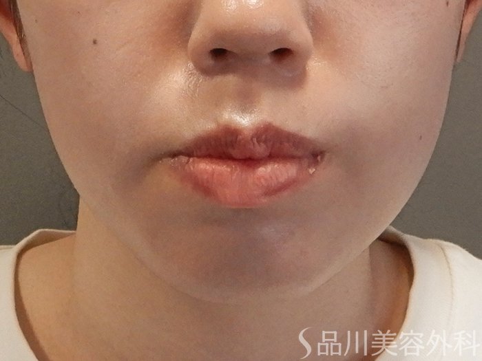 症例NO.70972のBEFORE写真
