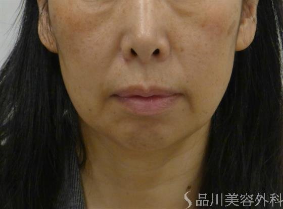 症例NO.50807のBEFORE写真