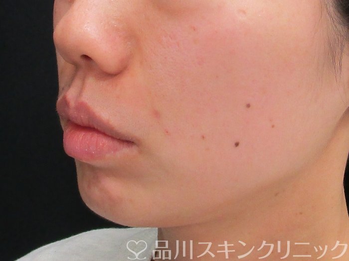 症例NO.72739のAFTER写真