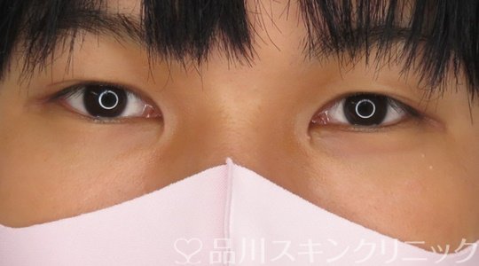 症例NO.71650のAFTER写真