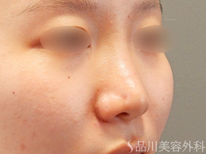 症例NO.71910のAFTER写真