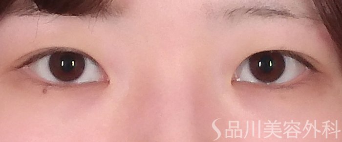 症例NO.69875のBEFORE写真