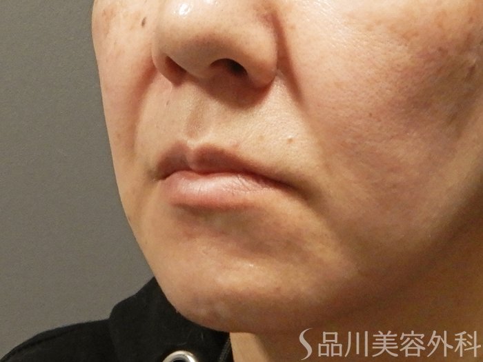 症例NO.67987のBEFORE写真