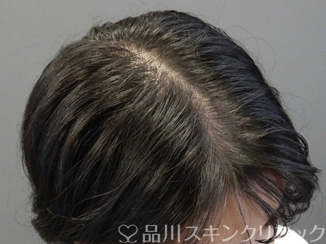 症例NO.69113のBEFORE写真