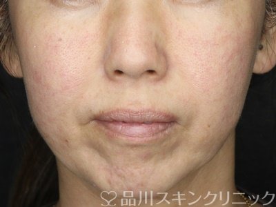 症例NO.73245のBEFORE写真