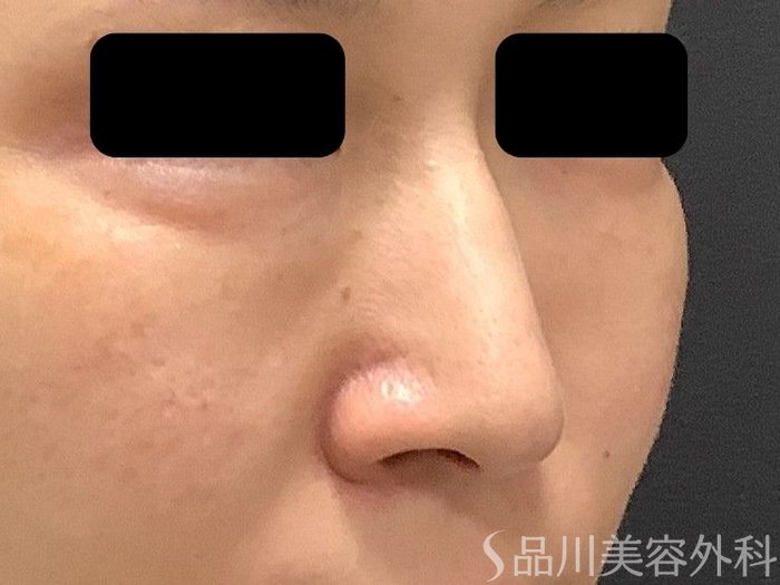 症例NO.75322のBEFORE写真