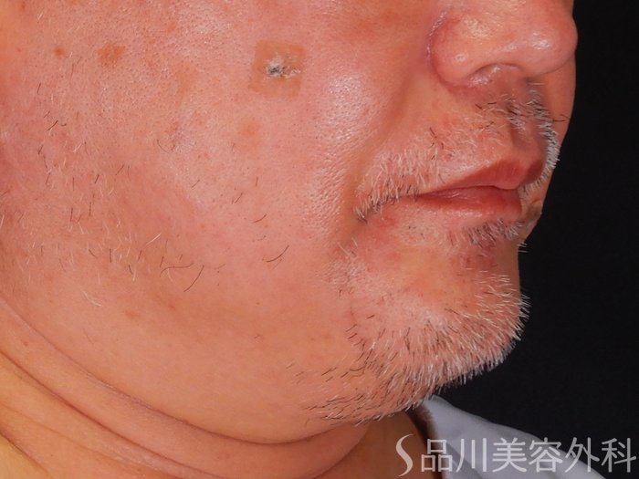 症例NO.69854のBEFORE写真