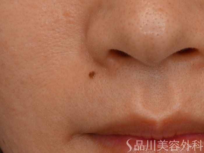 症例NO.72275のBEFORE写真