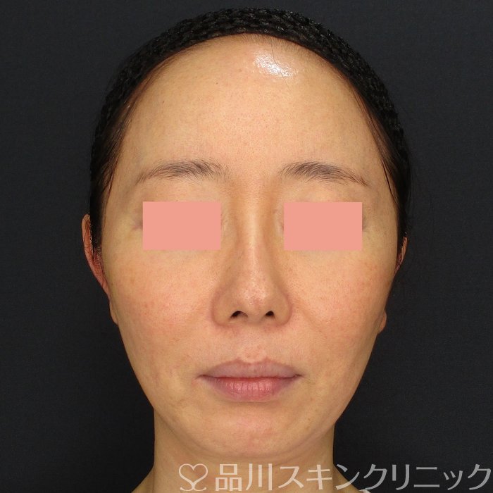 症例NO.72233のAFTER写真