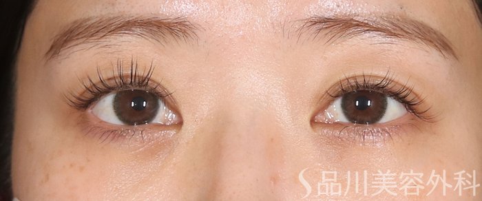 症例NO.72849のAFTER写真